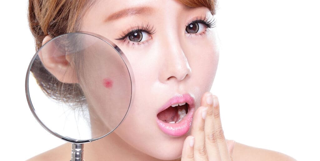 青春痘的治療方法有哪些?