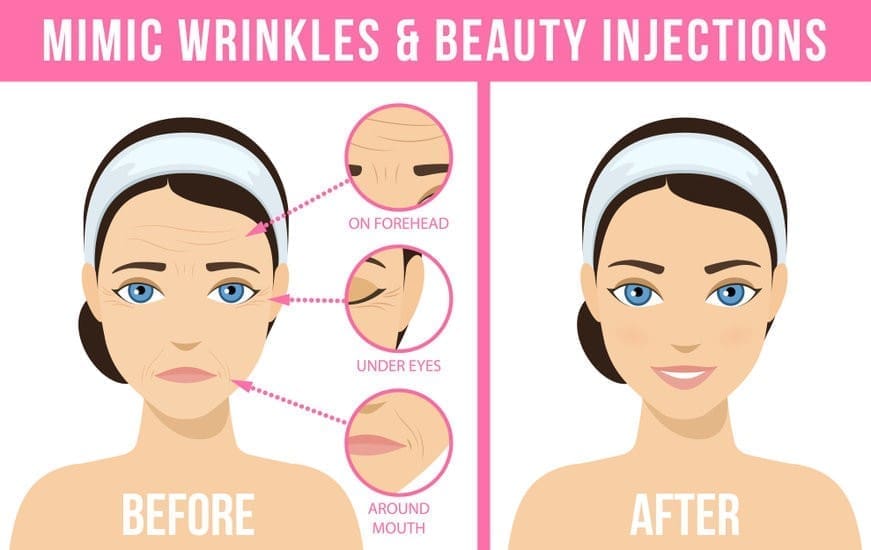 台中肉毒桿菌BOTOX