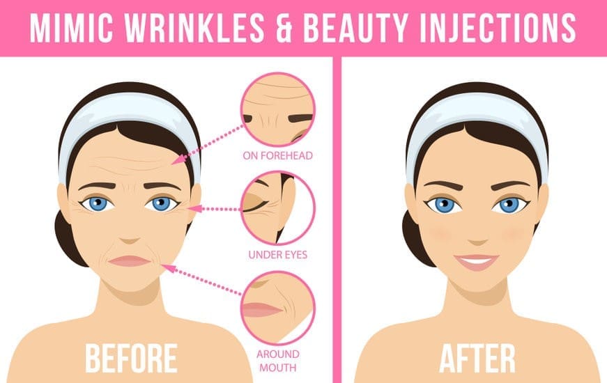 台中肉毒桿菌BOTOX