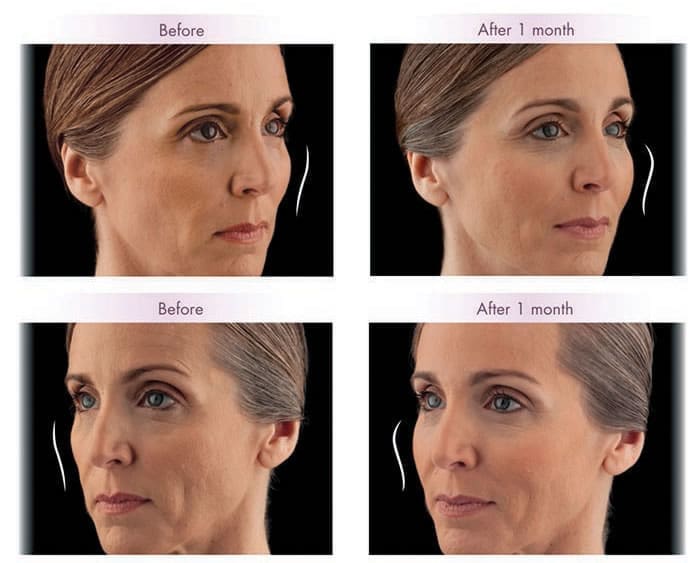 Voluma玻尿酸案例