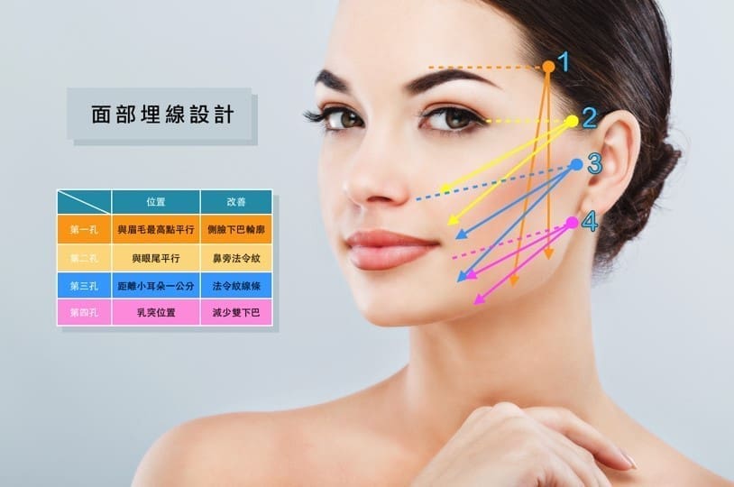 埋線拉提-術前規劃﻿