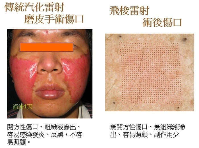 痘疤治療(雷射除疤)