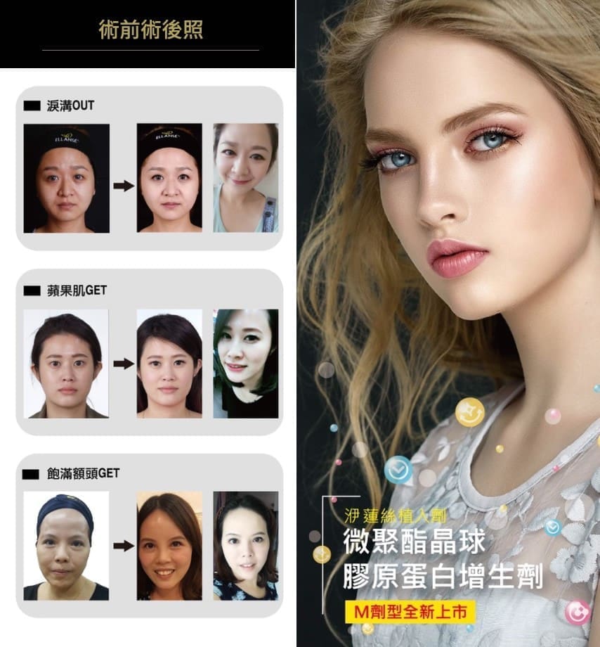 Ellanse(洢蓮絲) 可治療哪些部位?