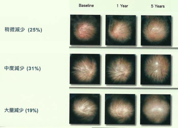 全頭照片評估顯示,大多病患者在5年內都不斷地掉髮