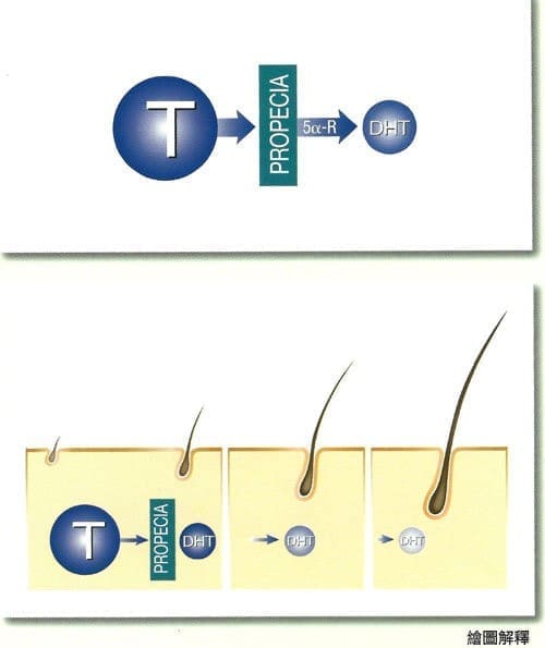 阻斷DHT經證實有治療雄性掉髮的療效
