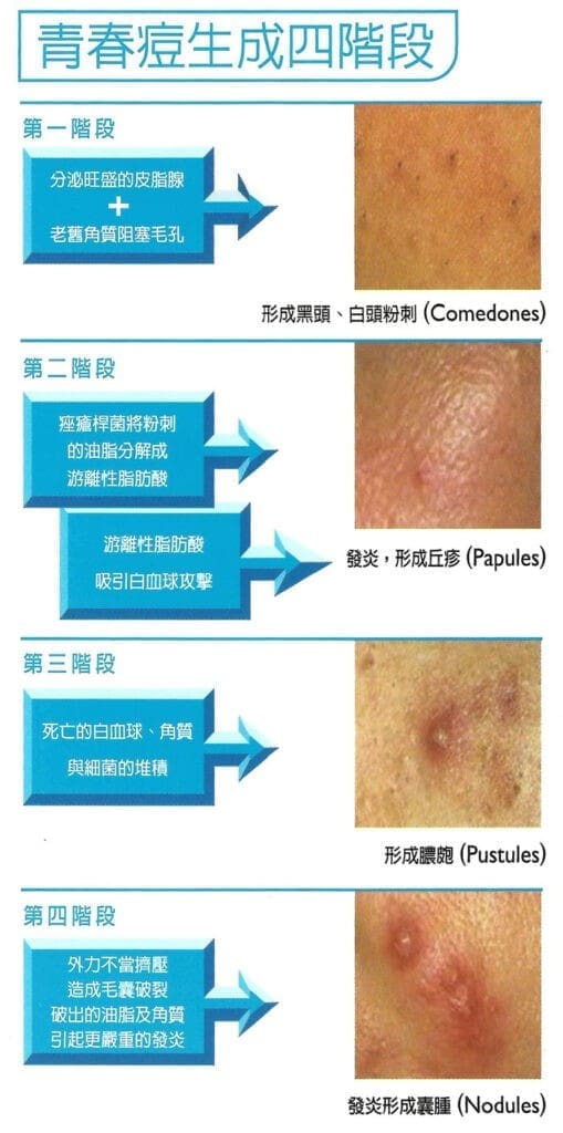 青春痘生成四階段