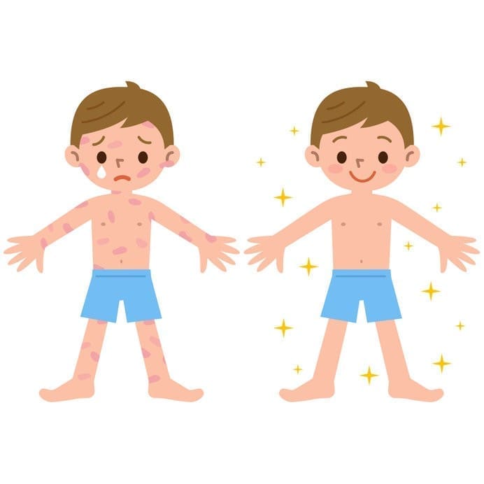 認識帶狀皰疹疫苗