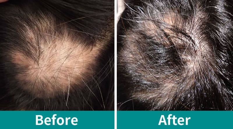 掉髮療程推薦自體生長因子育髮