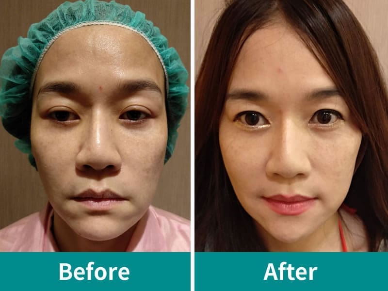 埋線拉提實例-術前術後效果