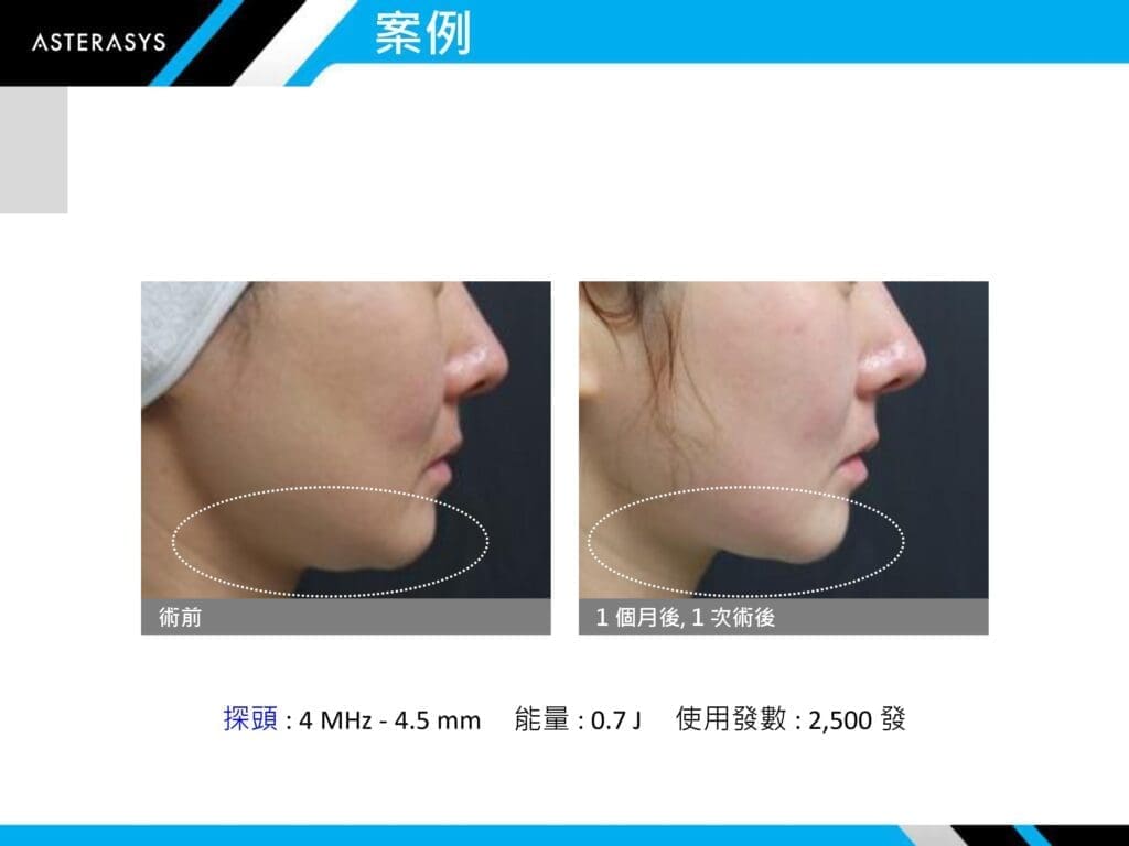 LV渦旋音波特點與實際案例