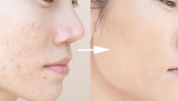 Acne Scar Treatment
