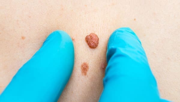 Mole & Spot Removal