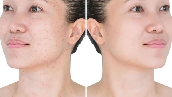 Do You Have Dermatitis and Eczema?