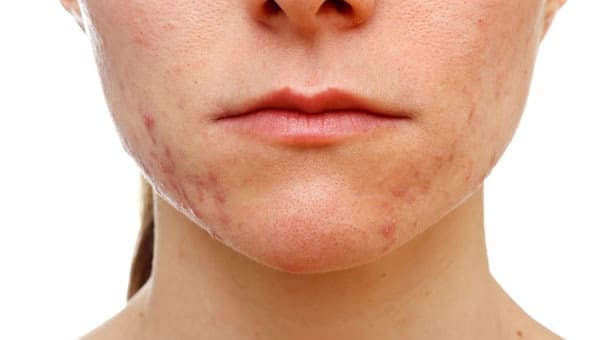 Do You Have Infectious Skin Diseases?