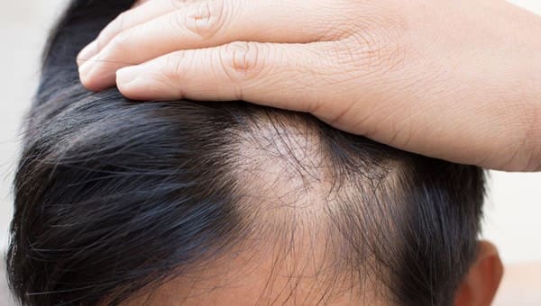 Concerned About Hair Loss?