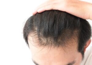 Male Hair Loss
