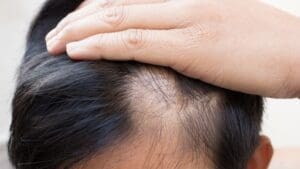 Bald Spots Treatment